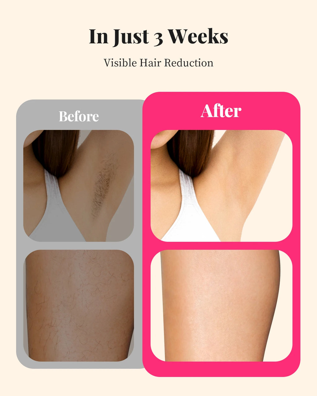 990000 Flashes Hair Removal for Women and Men IPL Hair Removal